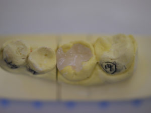 セラミックインレー.002