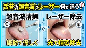 舌苔の超音波除去とレーザー除去の違い